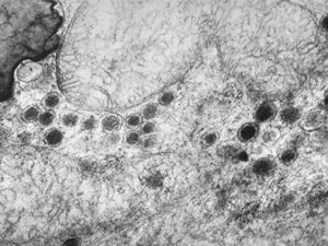 F,36y. | chemodectoma - neck F,36y. | chemodectoma - neck